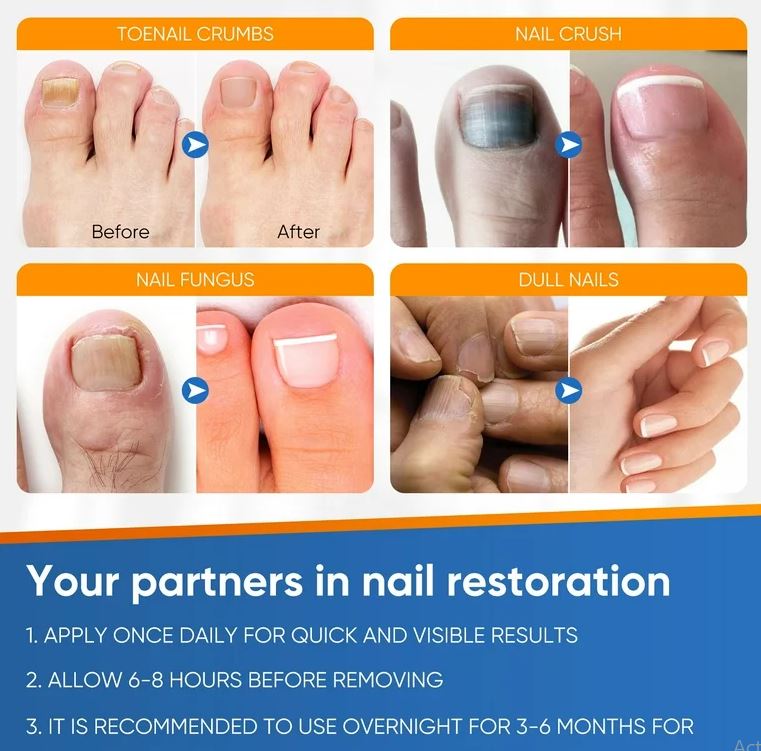 Nail X Cream– 100% Ayurvedic Nail Repair Cream | Powerful Toenail & Fingernail Fungus Treatment- WURDHI Cream -MaxiGrow Herbal Cream Enlargement Cream 100% Ayurvedic. 