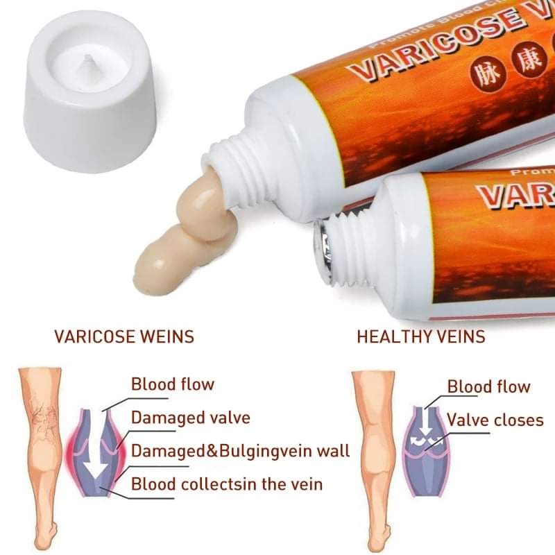 Effective Varicose Veins Relief Cream Relieve Vasculitis Phlebitis