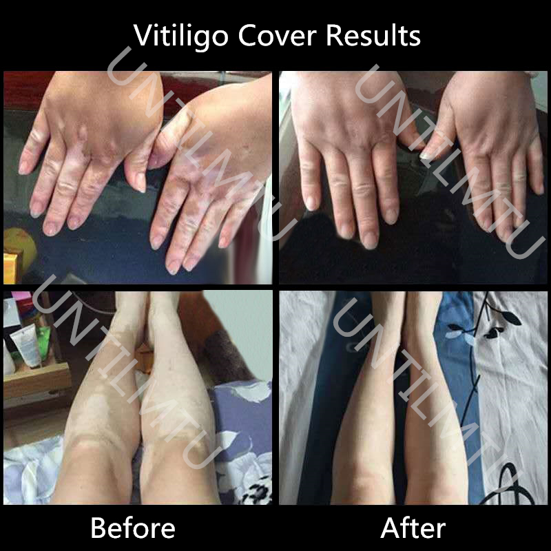 Vitiligo Covering Waterproof Skin Condition Concealer Pen Long Lasting Women Men White Patch Face Body Spots Makeup. 