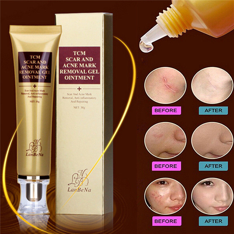 lan be na tcm scar and acne mark removal gel ointment