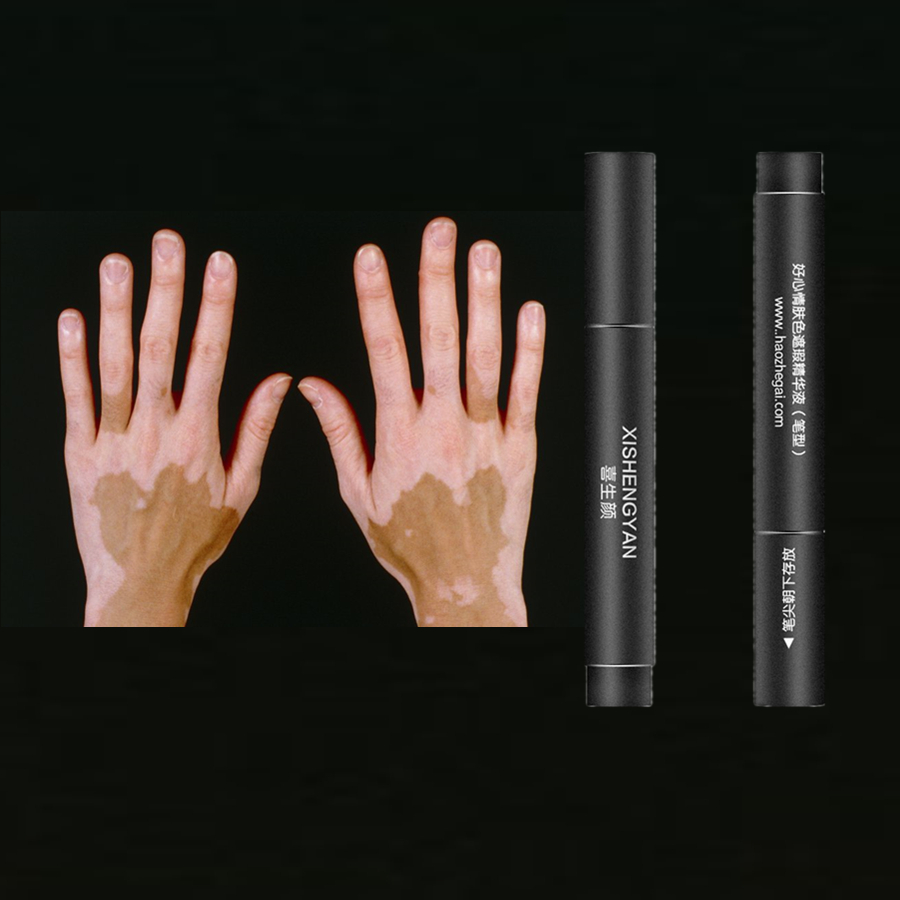 Vitiligo Covering Waterproof Skin Condition Concealer Pen Long Lasting Women Men White Patch Face Body Spots Makeup. 