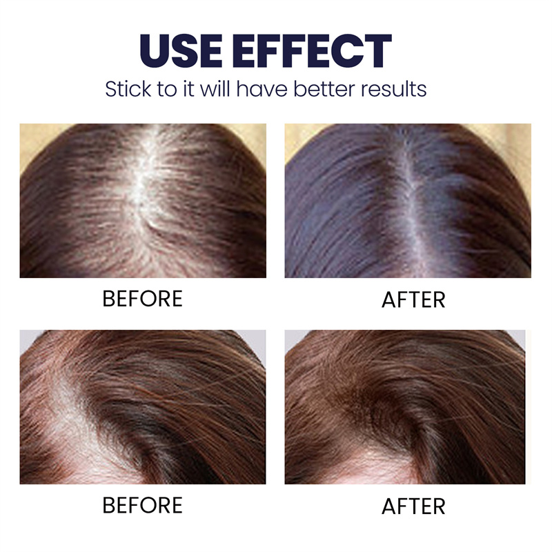 30ML Ginger Root Hair Growth Serum Anti Preventing Hair Loss Alopecia Liquid Damaged Hair Repair Growing Faster. 