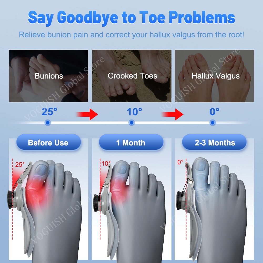 Bunion Splint Big Toe Straightener Corrector Foot Pain Relief Hallux Valgus Correction Orthopedic Supplies Pedicure Foot CareHats & Caps. 
