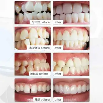 teeth alignment for adults