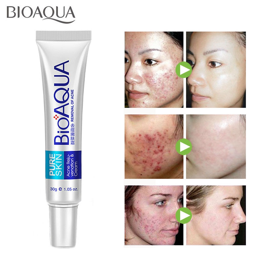 Original_ Natural Ingredient BIOAQUA PURE SKIN Anti Acne Scar Mark Remove  Oil Control Shrink Pores Remove Pimples Blackhead Anti-Wrinkle Treatment  Removal Cream Spots Scar Blemish Marks (Baps): Buy Online at Best Prices