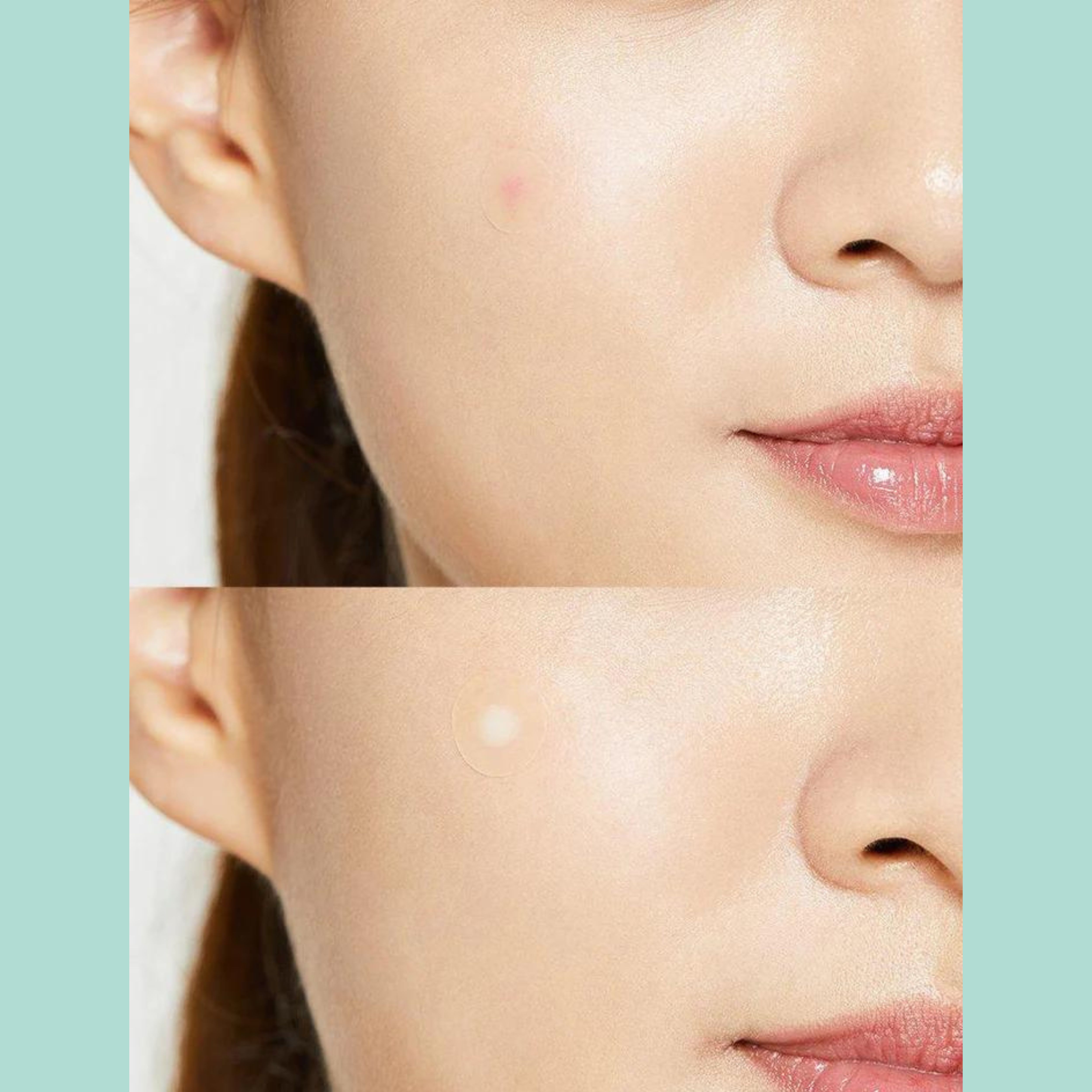 COSRX Acne Pimple Master Patch (24 patches/1ea). 